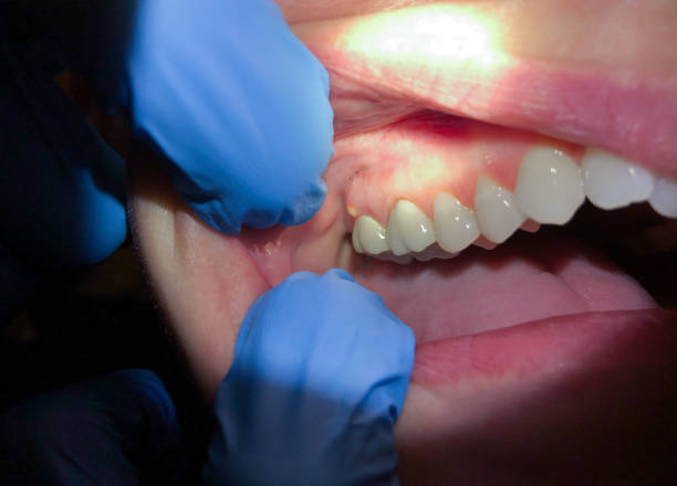 Best Emergency Denture Repair in Lacoste, TX